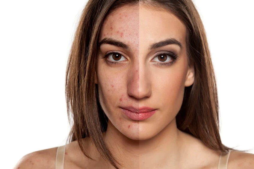 How to Get Rid of Acne Scars in a Week: Effective Treatment and Makeup Tips